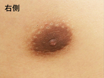症例