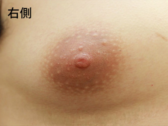 症例
