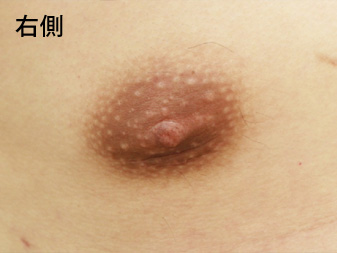 症例