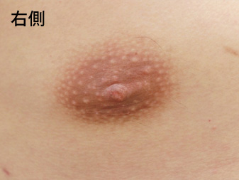 症例