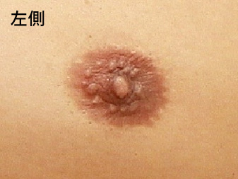 症例
