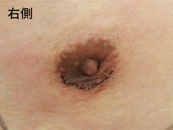 症例