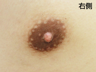 症例