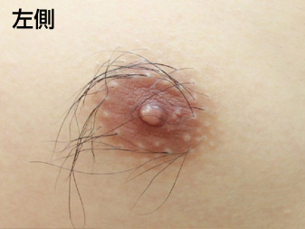 症例