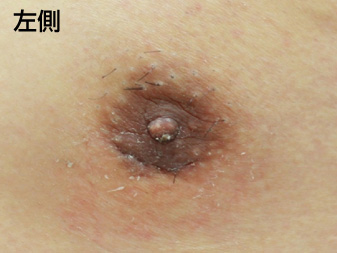 症例
