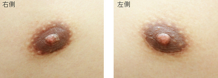 症例